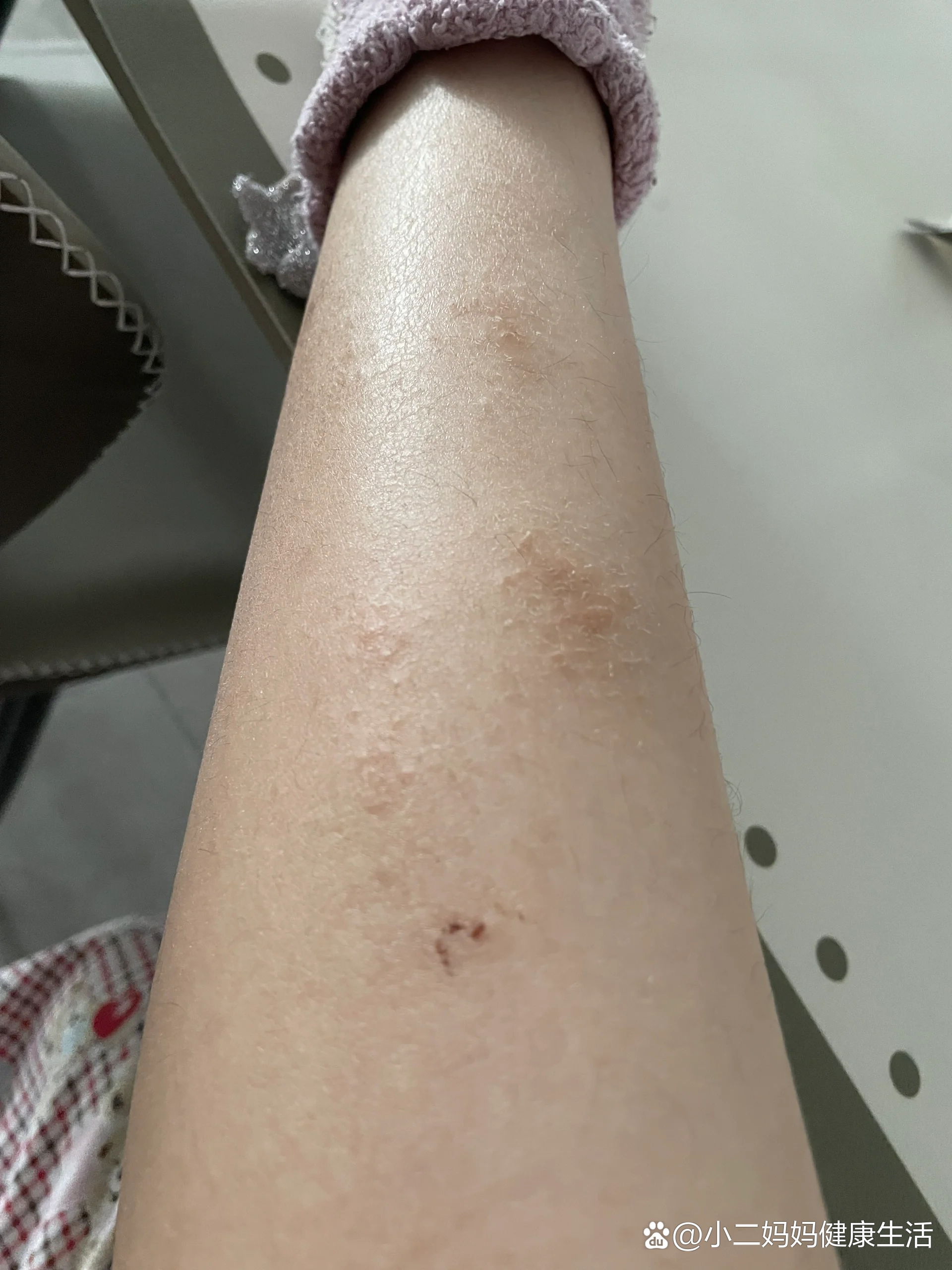 为什么跑步腿会痒