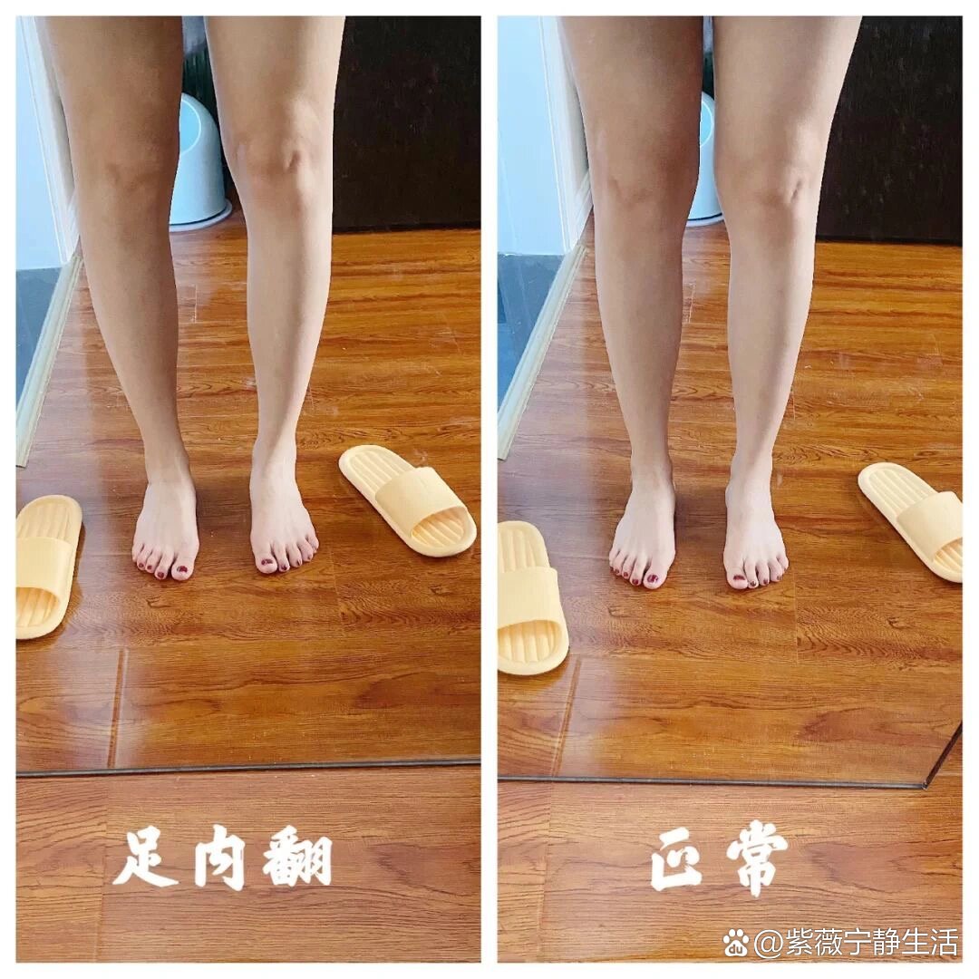 矫正足内翻/改善腿形,变直,瘦腿