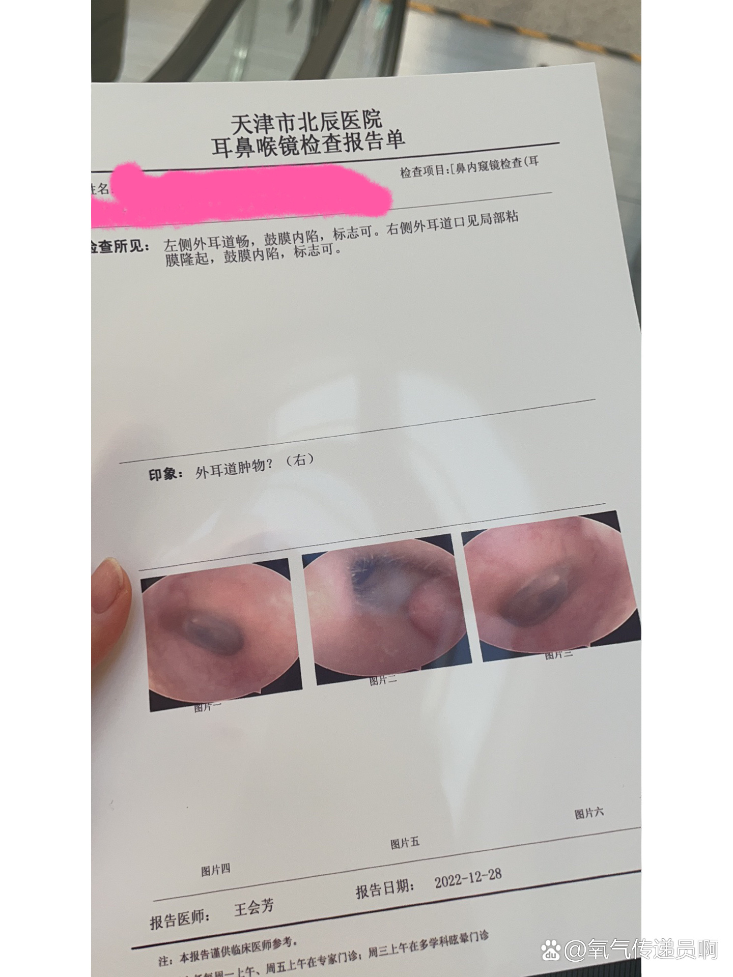 莫名其妙外耳廓里长了个疙瘩