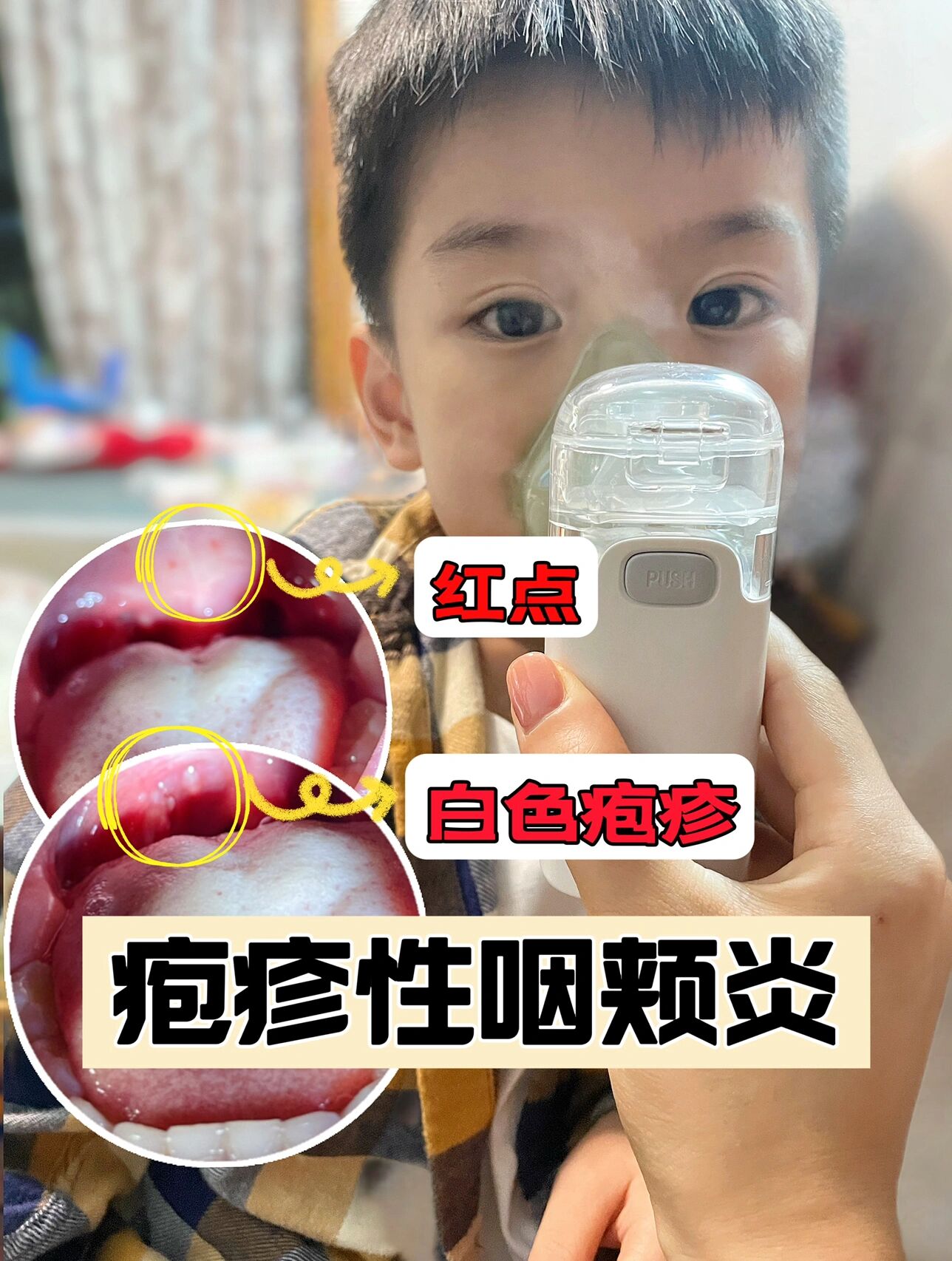 孩子疱疹性咽颊炎