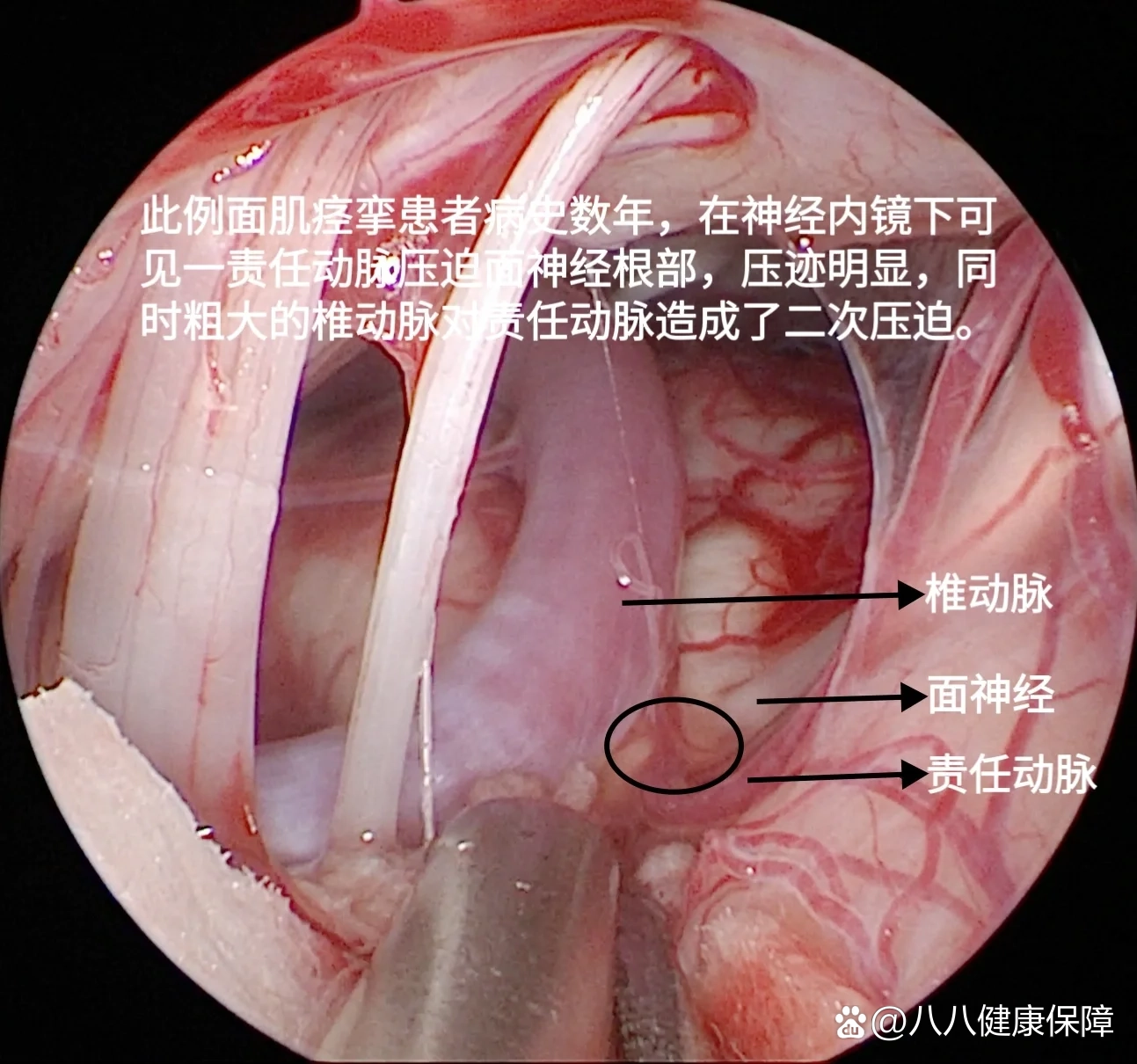 面神经减压手术图片