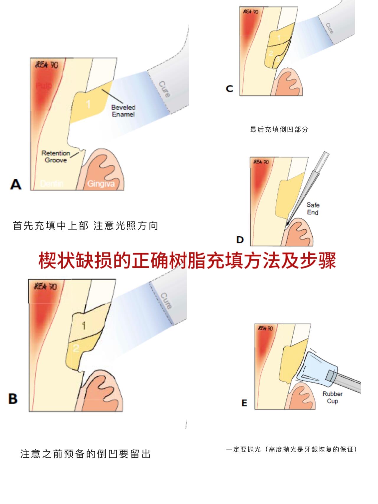 牙齿楔状缺损怎么治疗图片