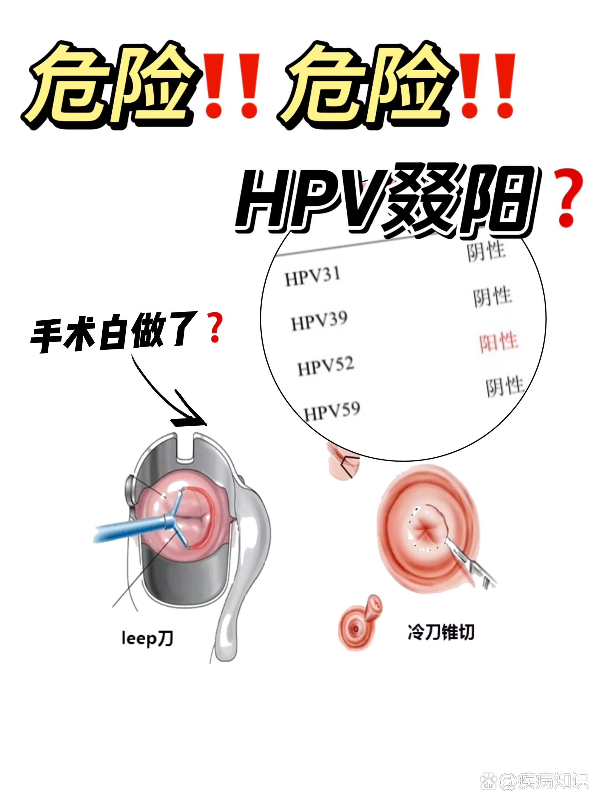 宫颈锥切图片示意图图片