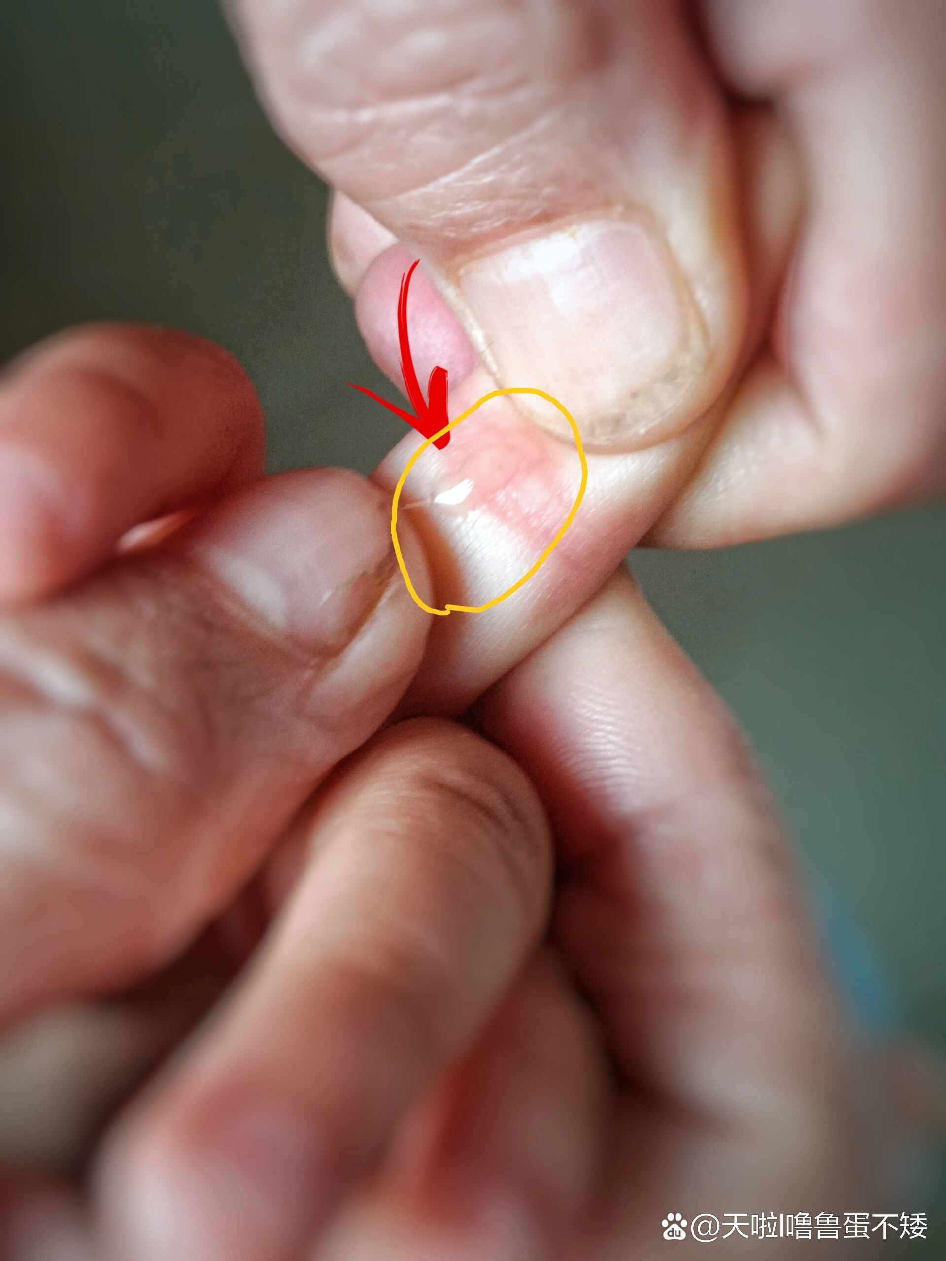 圆宝宝让外婆给他挑疳积,正好侄女今天一早起来就胃难受,呕,去看医生