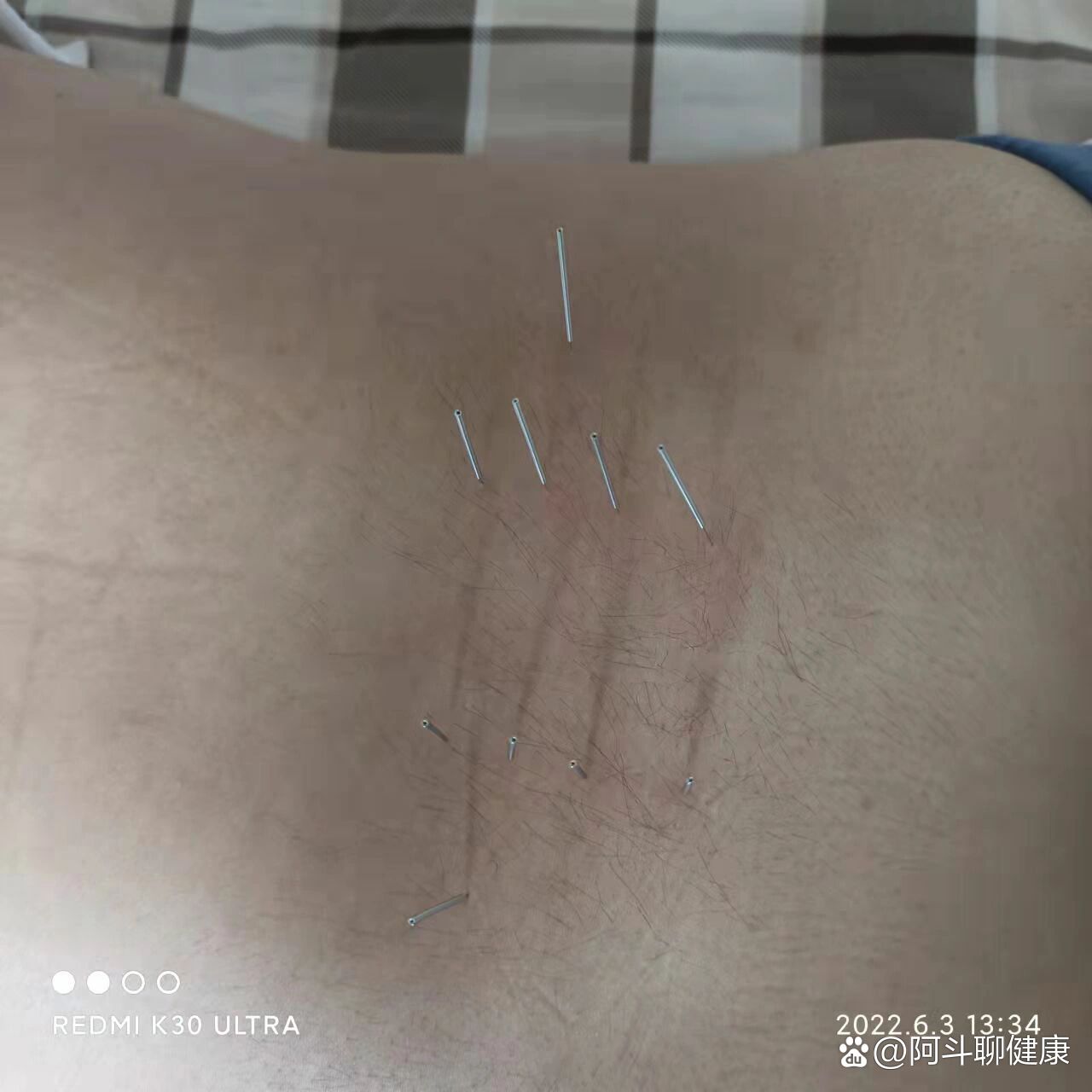 腰间盘突出,针灸腰部.