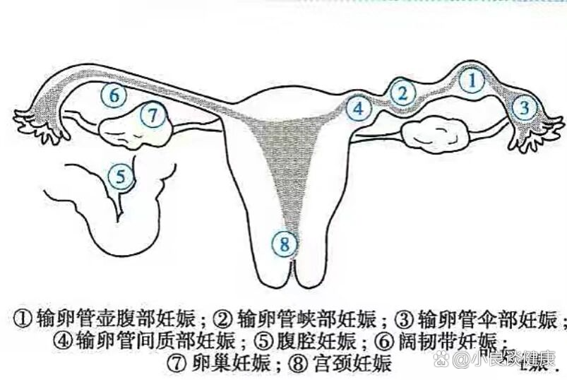 异位妊娠最常见的部位图片