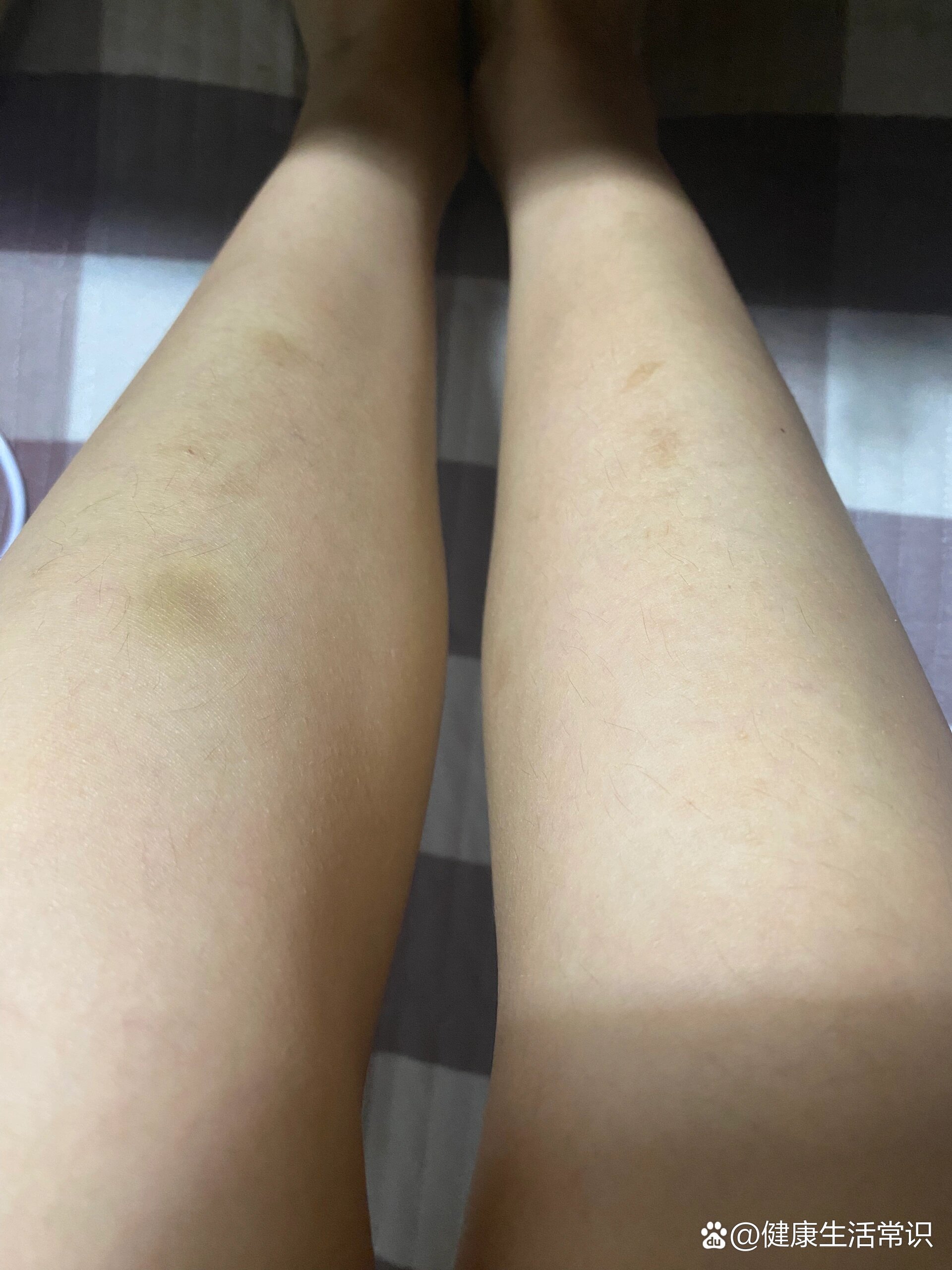 为什么小腿会时不时有这种淤青