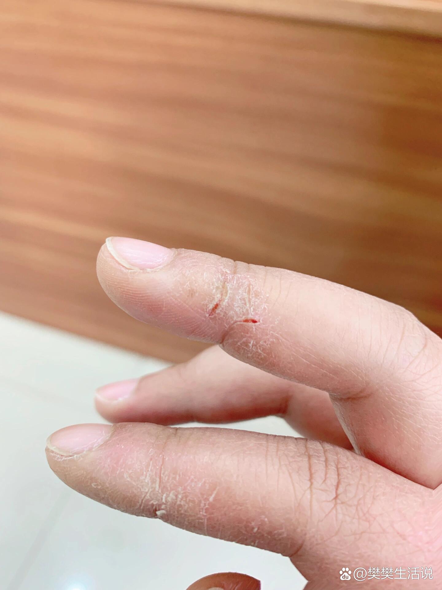 手指开裂变严重了!