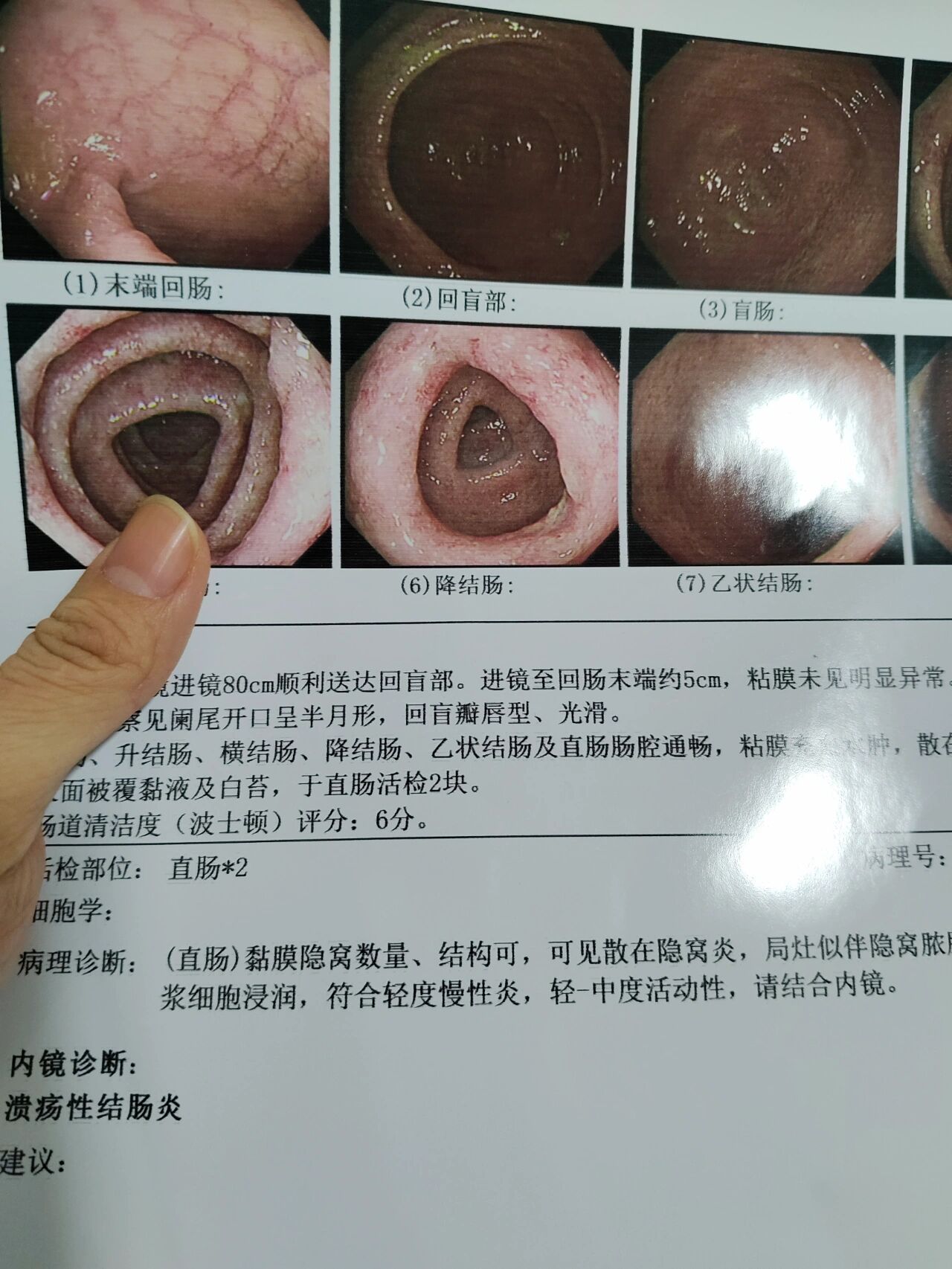 结直肠炎 全网资源