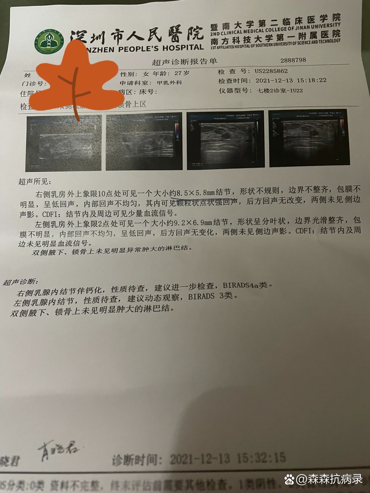 乳腺结节4a类严重吗图片