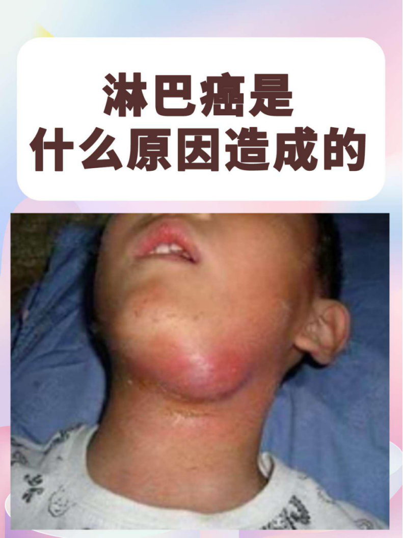 淋巴癌揭秘:这些原因你可能从未想过!