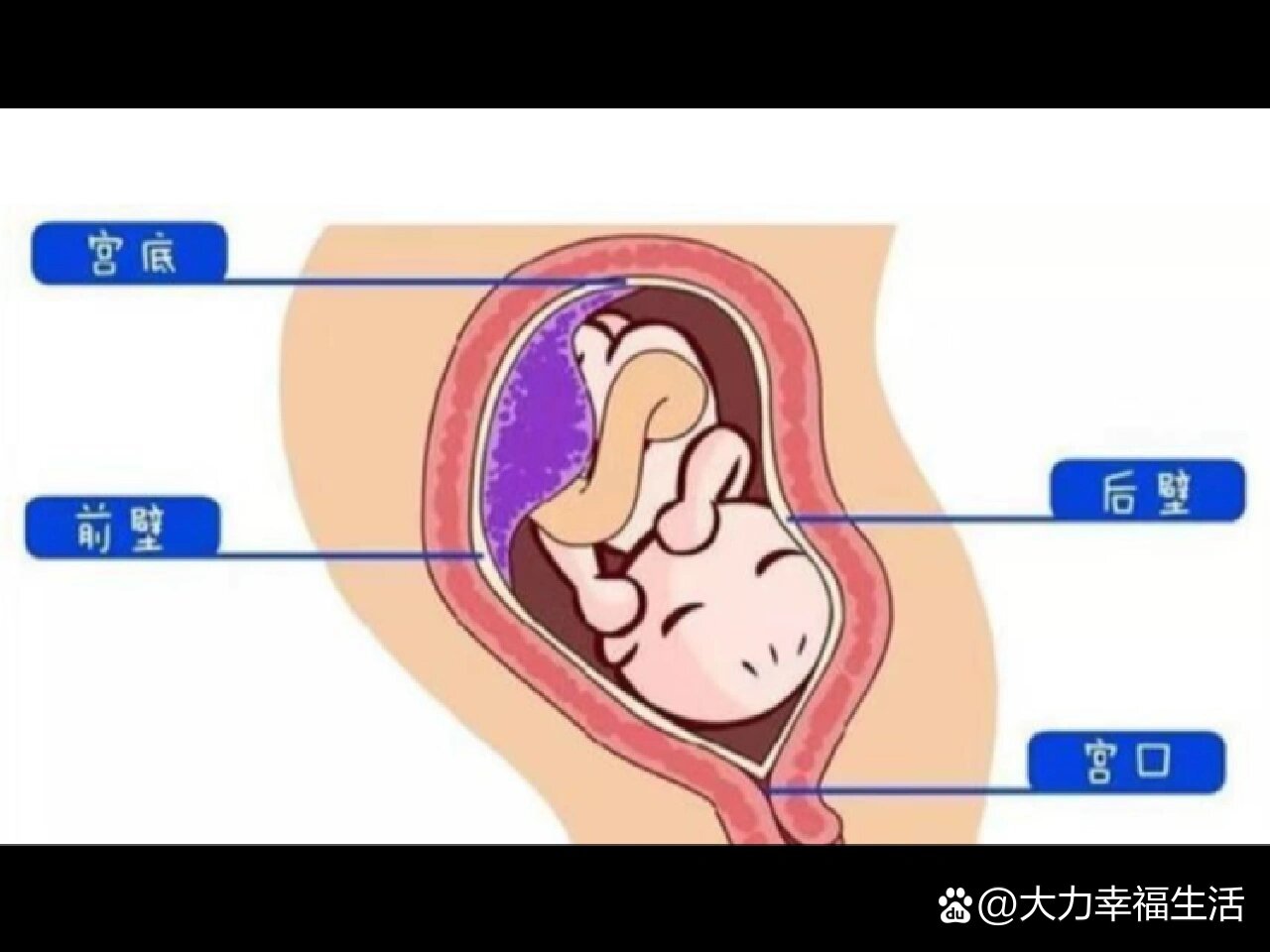 胎盘前壁后壁区别