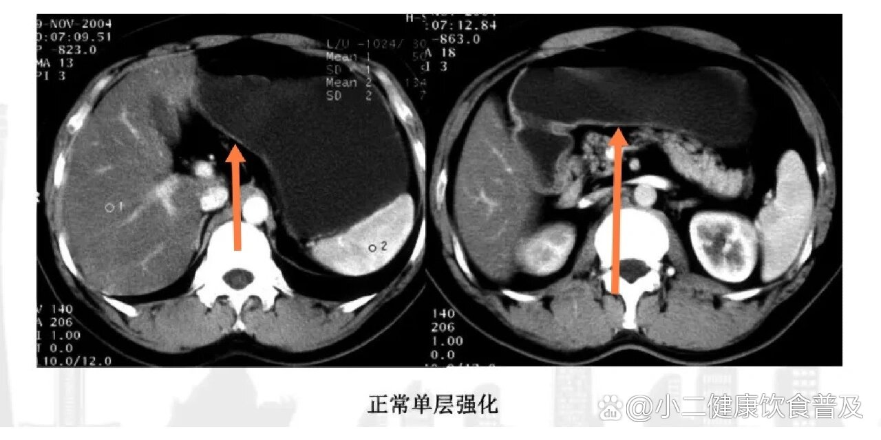 胃的ct横断面解剖