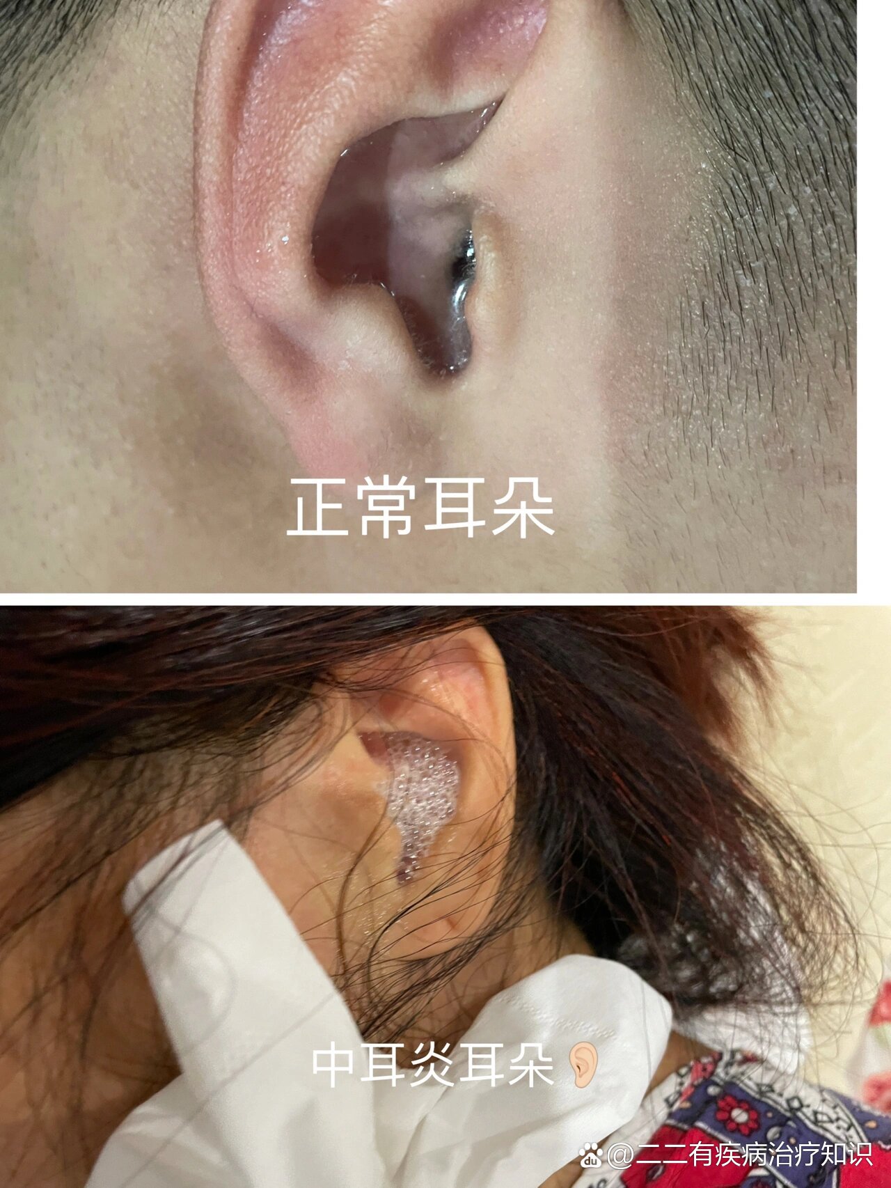 中耳炎使用双氧水清洗