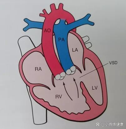 右心室位置图图片