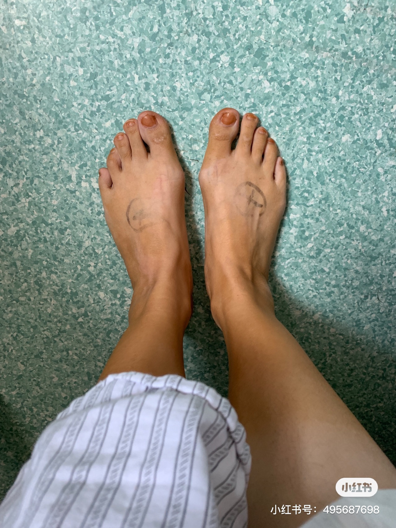 拇外翻手术第24天(术前后对比图)