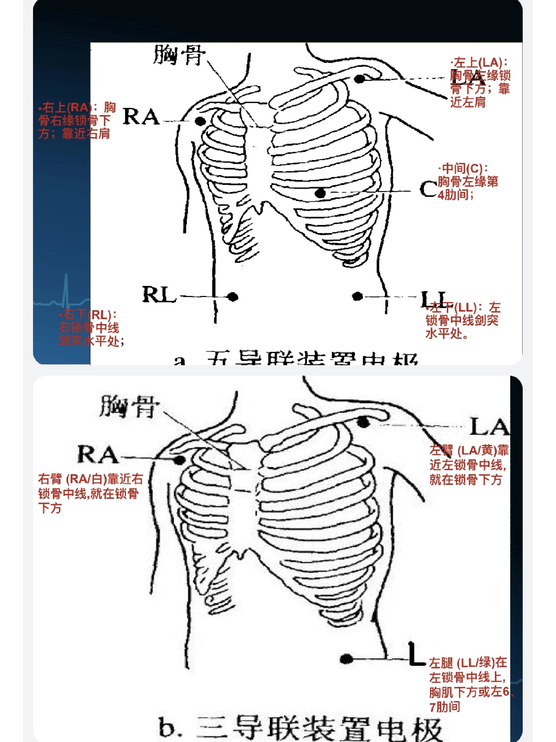 怎么做心电图步骤图片图片