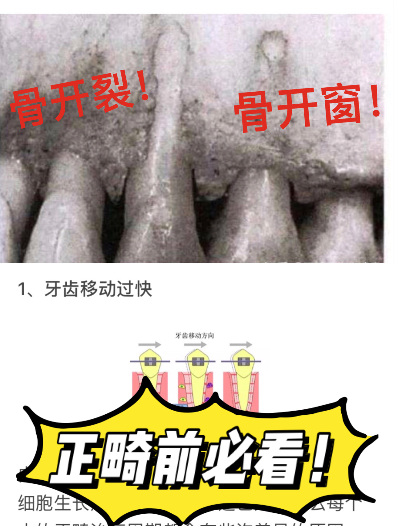 1️⃣左边这颗牙,就是缺损的牙槽骨和黏膜组织范围到达牙槽嵴顶部