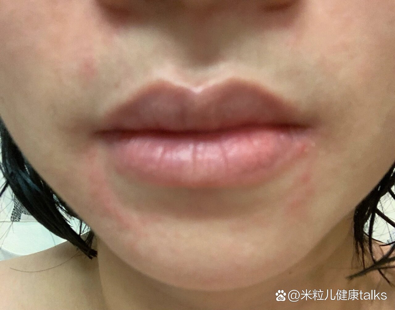  p>嘴角俩侧总是这样红的 br>是过敏呢?还是什么皮肤问题啊?