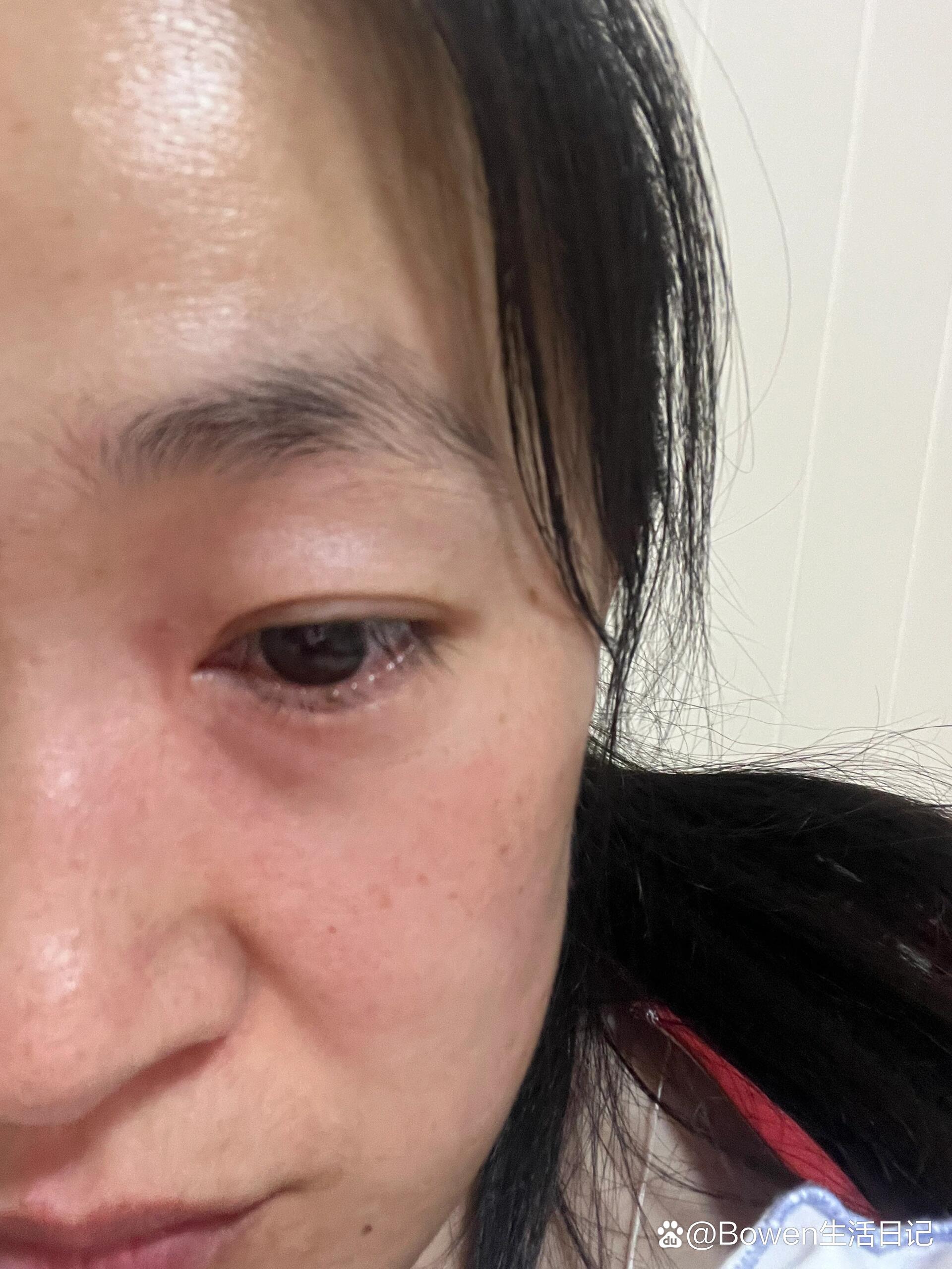 长在眼角的脂肪粒今天让我给挤掉了