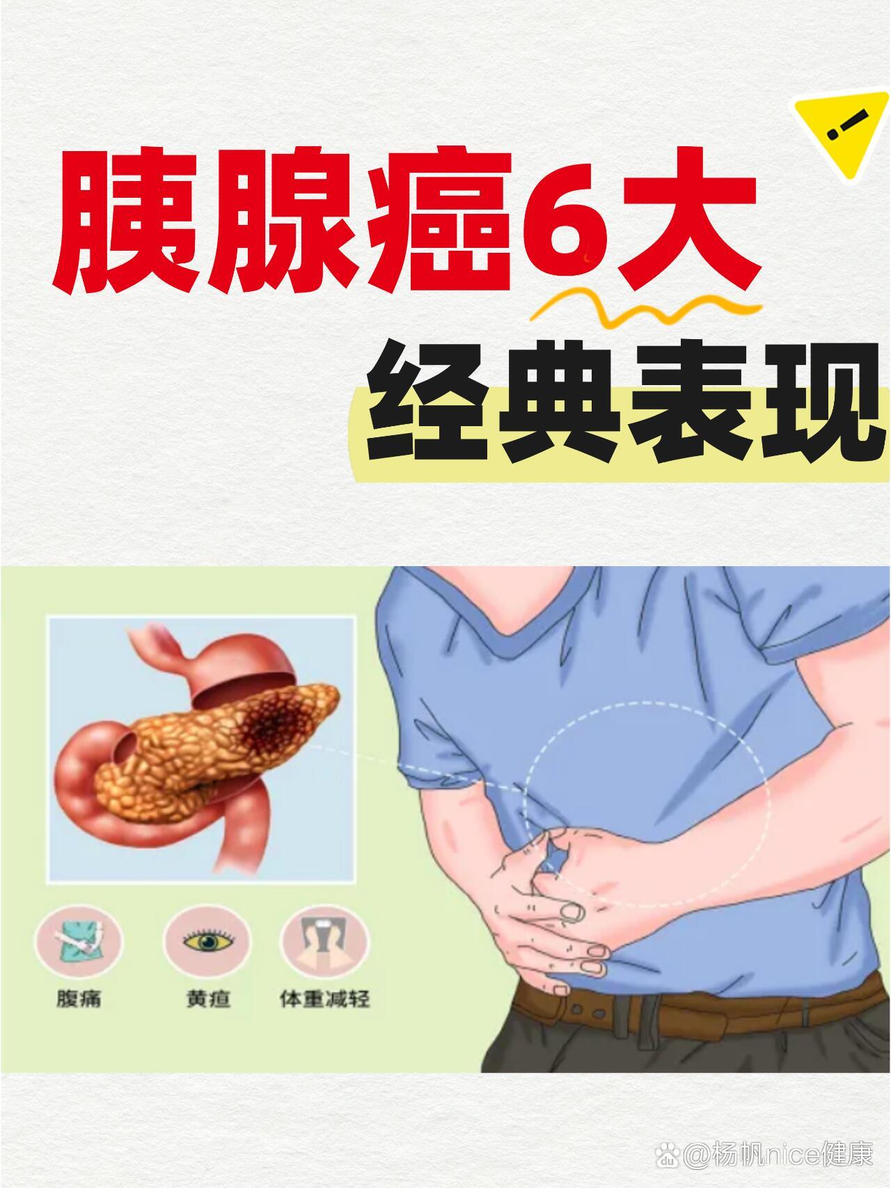 胰腺癌的6大表现