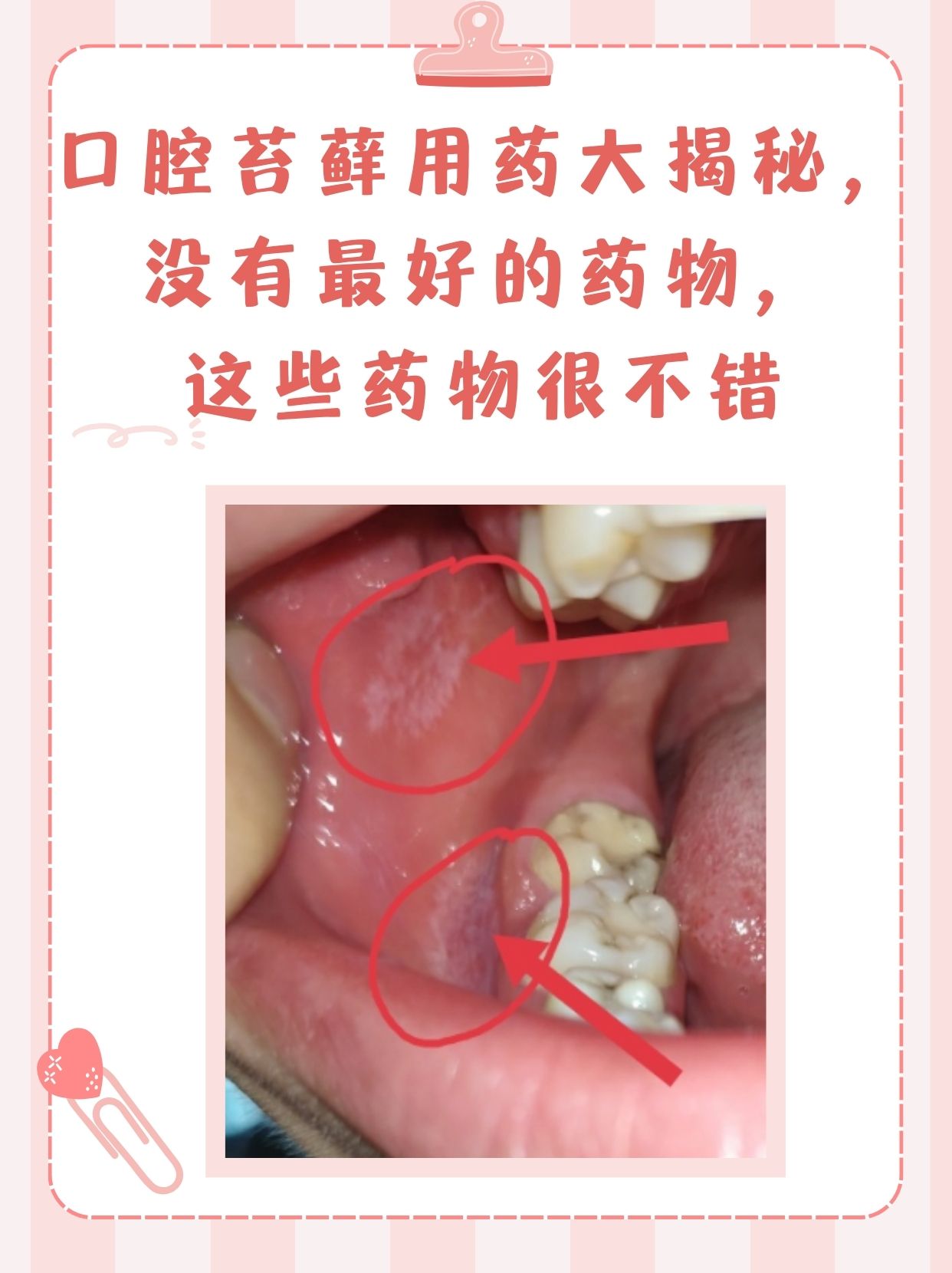 扁平苔藓的治疗方法图片