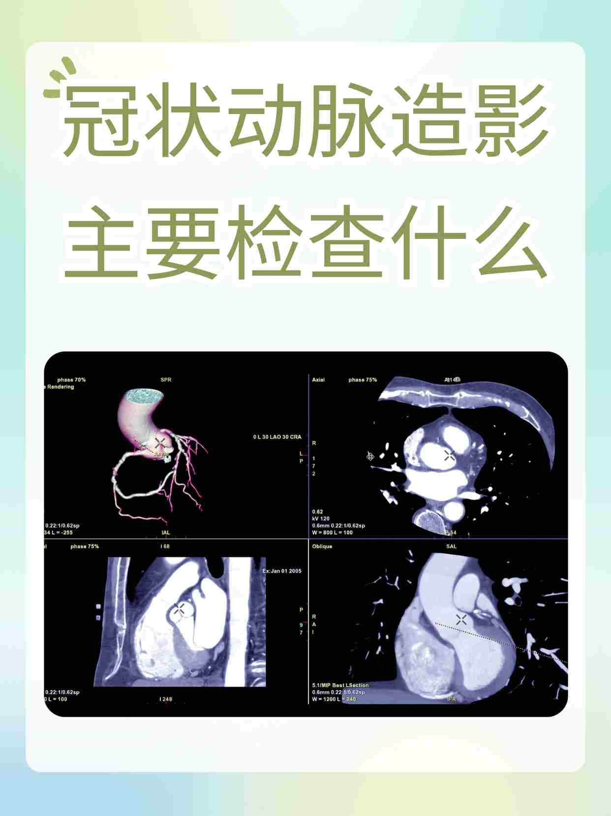 冠状动脉造影图详细图图片