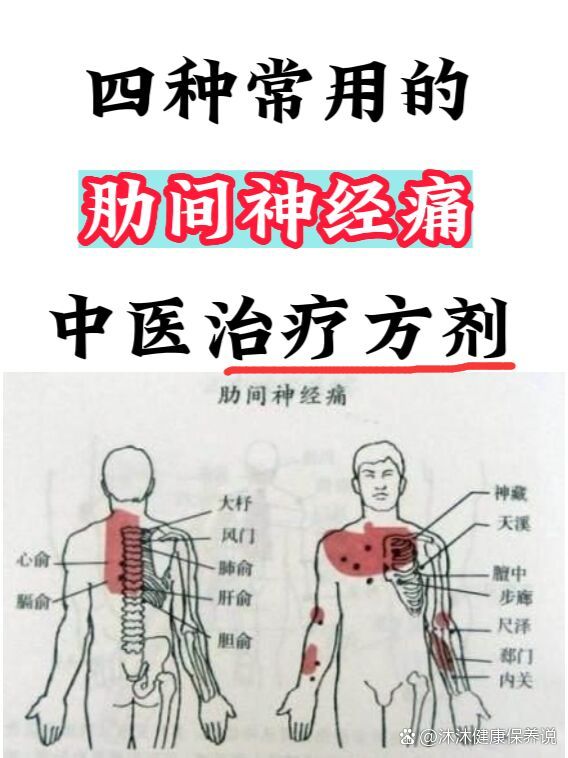 肋间神经痛,临床最常用的四种方剂!