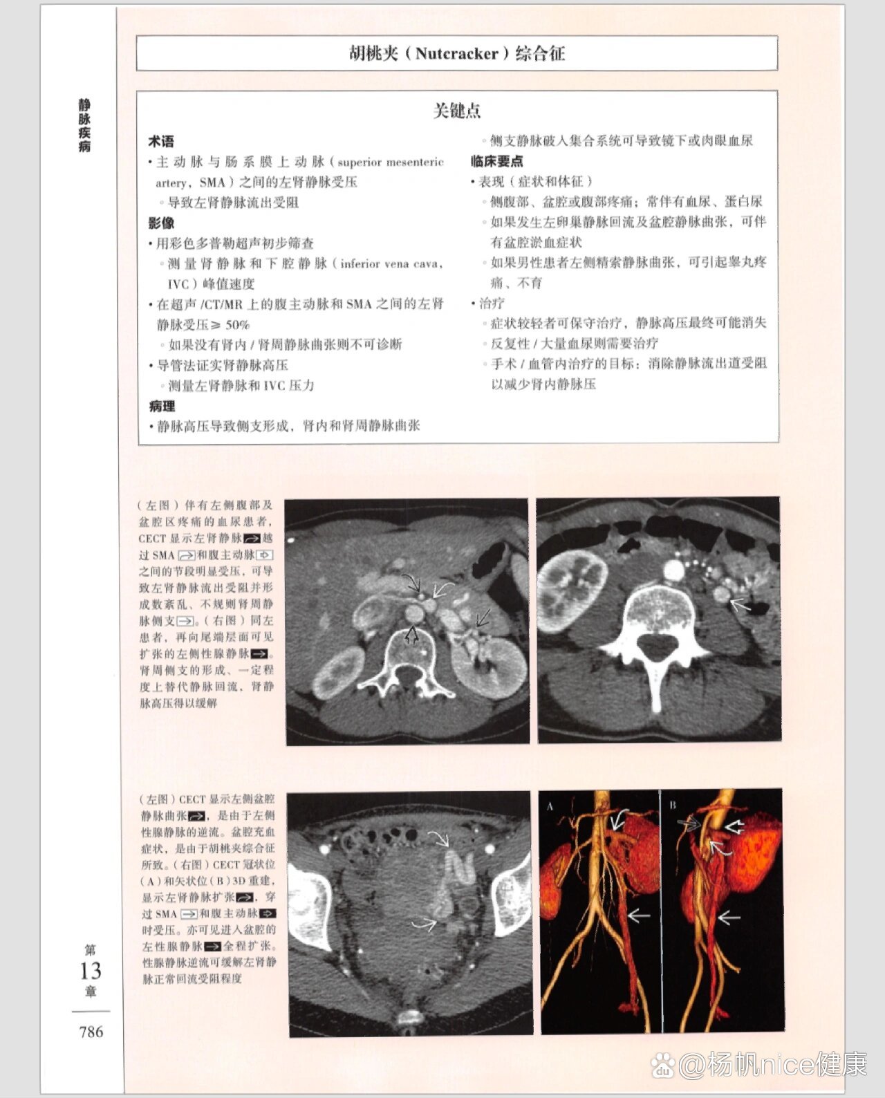 胡桃夹综合征超声诊断图片