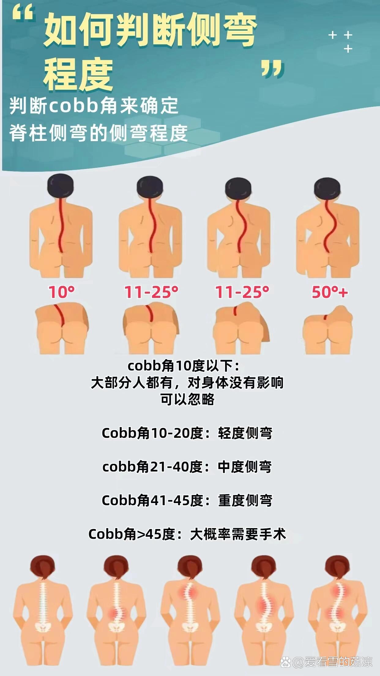 腰椎轻度侧弯图片