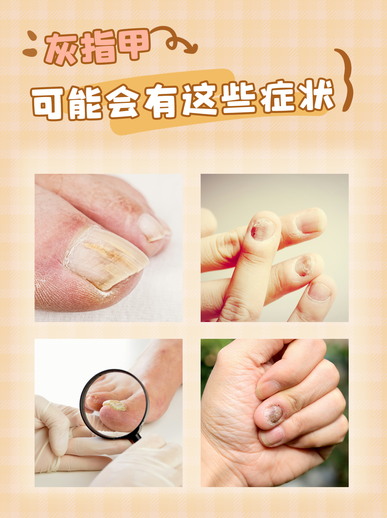 这些症状可能提示我们有灰指甲!