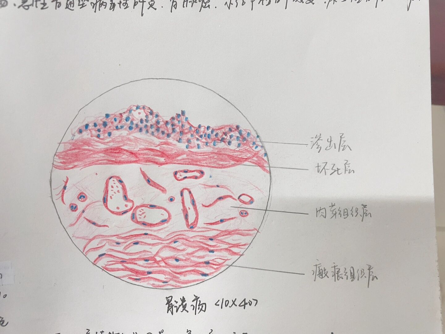 胃溃疡病理手绘图图片