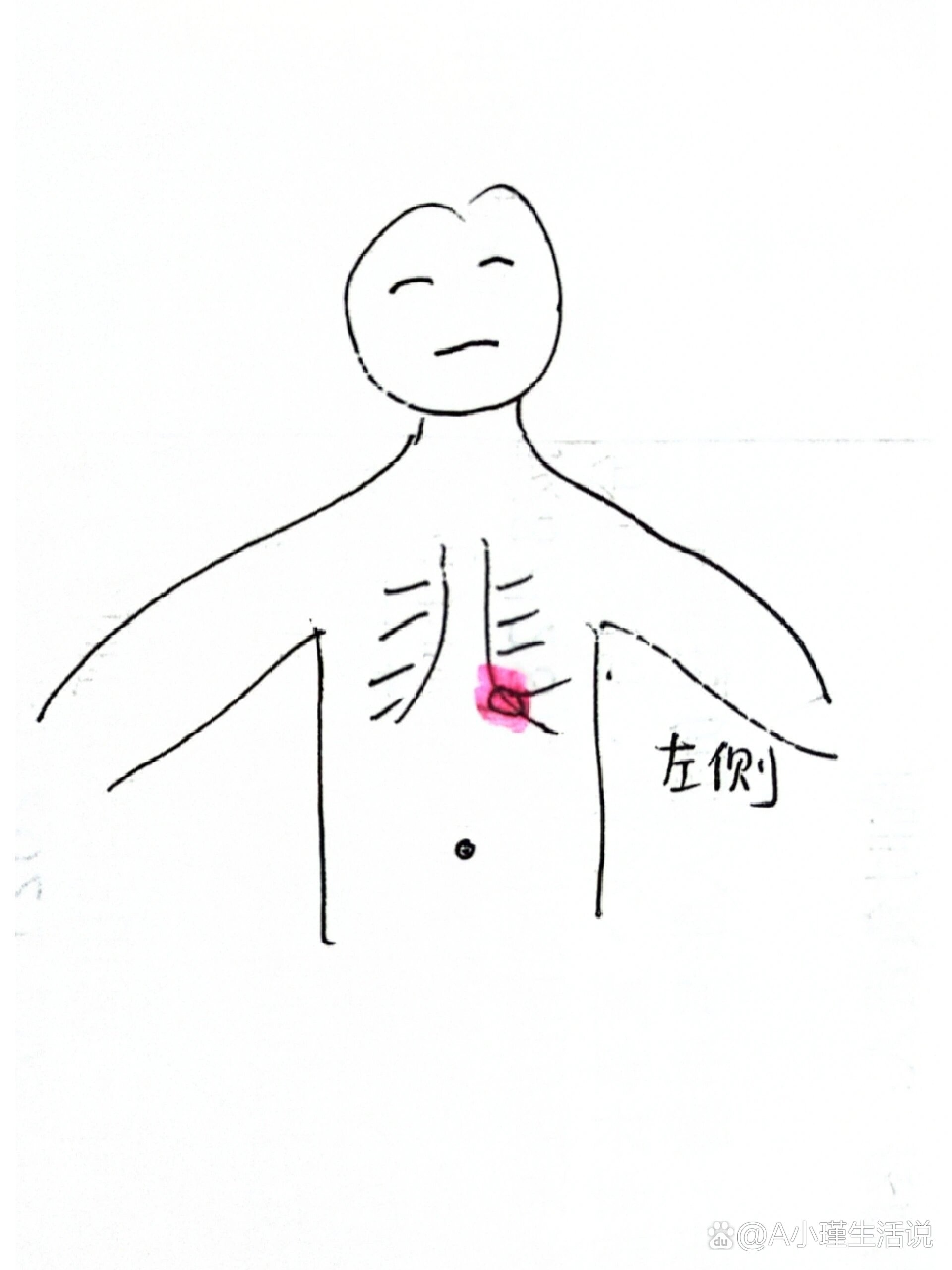 左侧肋骨下方疼图片图片