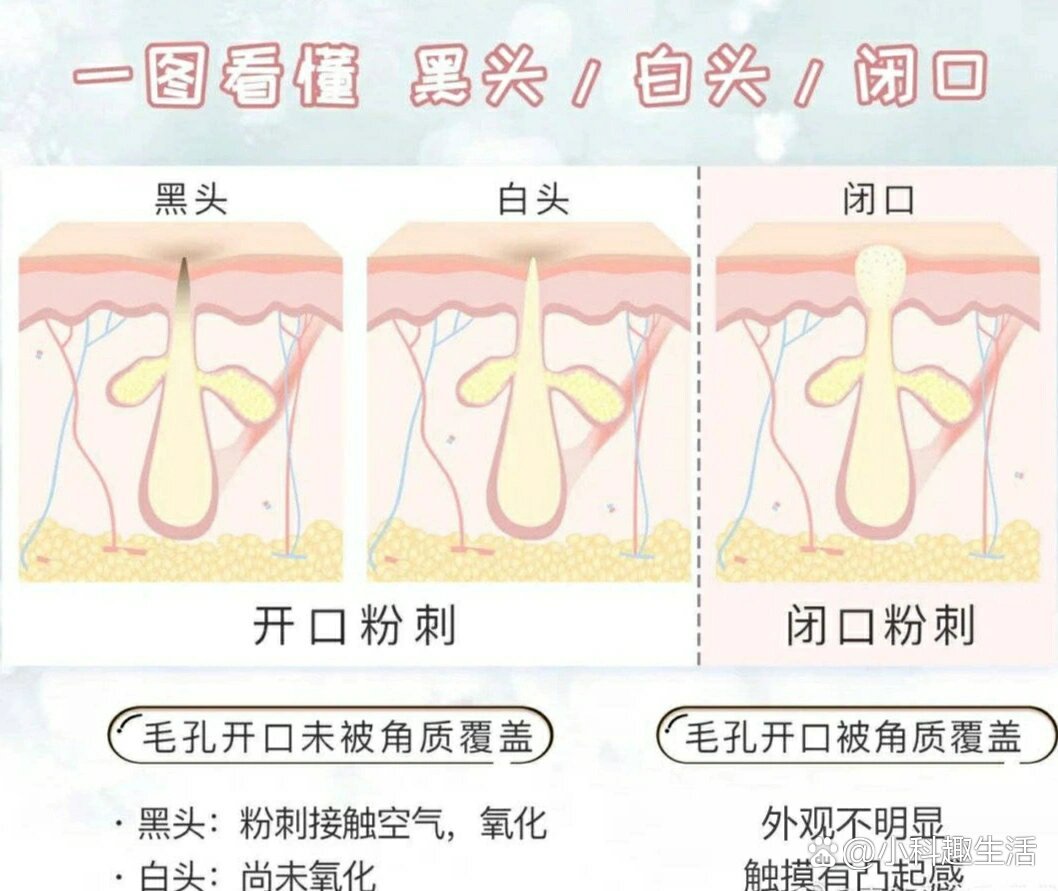 一图看懂你分不清的开口和闭口粉刺