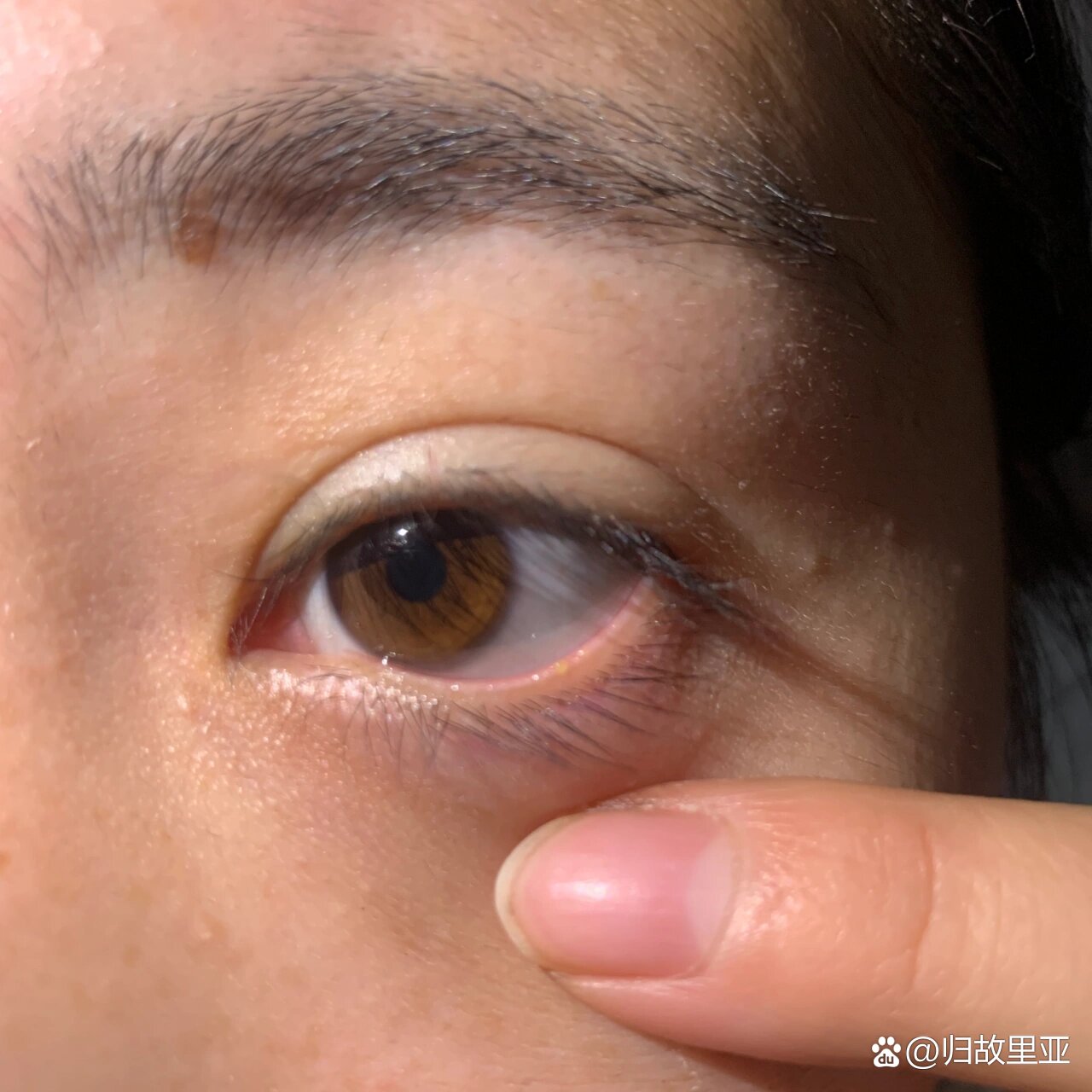 下眼睑经常长水泡是什么原因