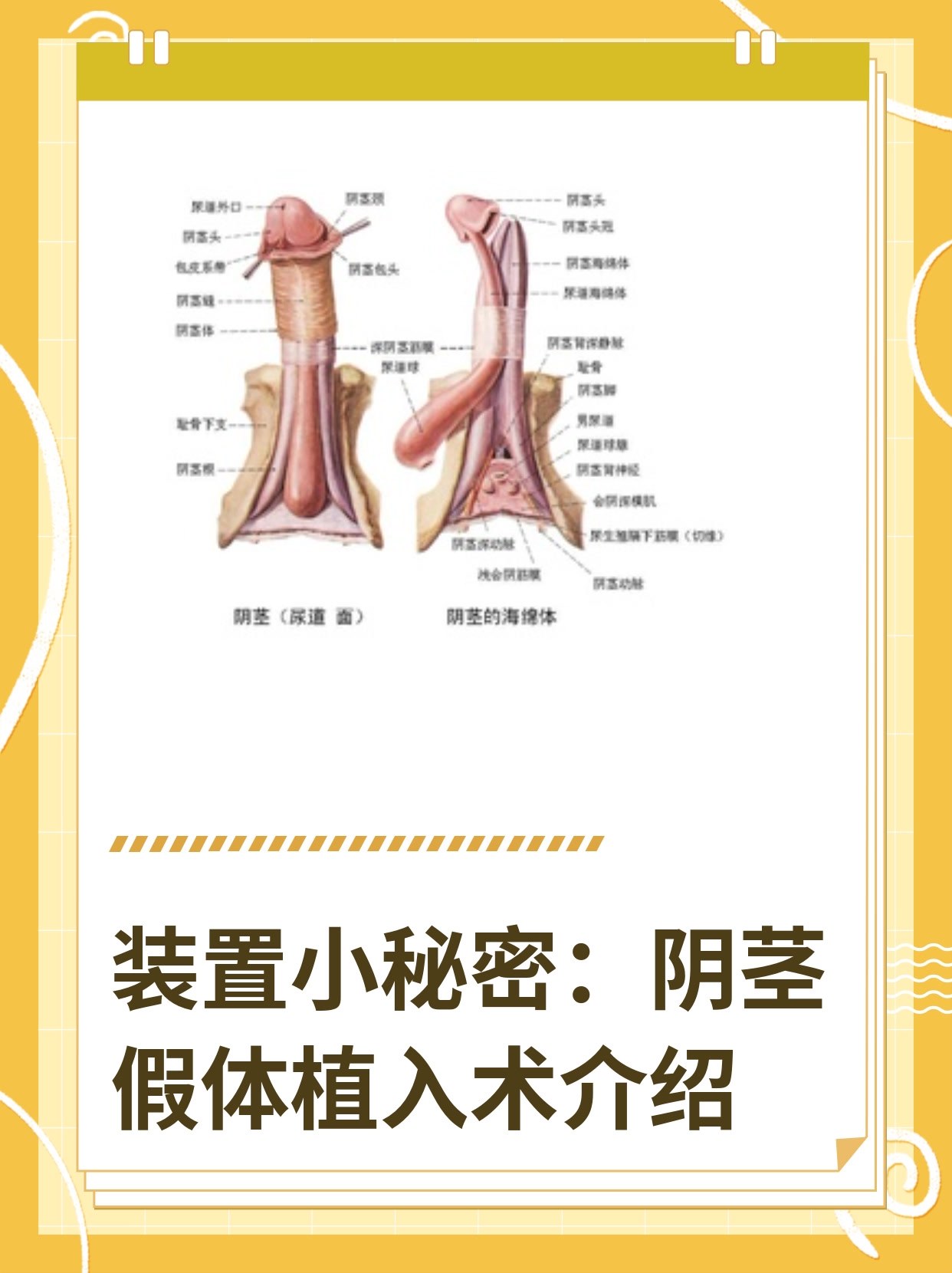 男科假体植入术图片