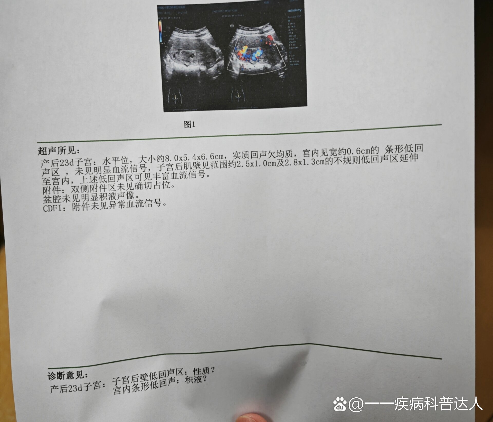 子宫动静脉瘘治愈