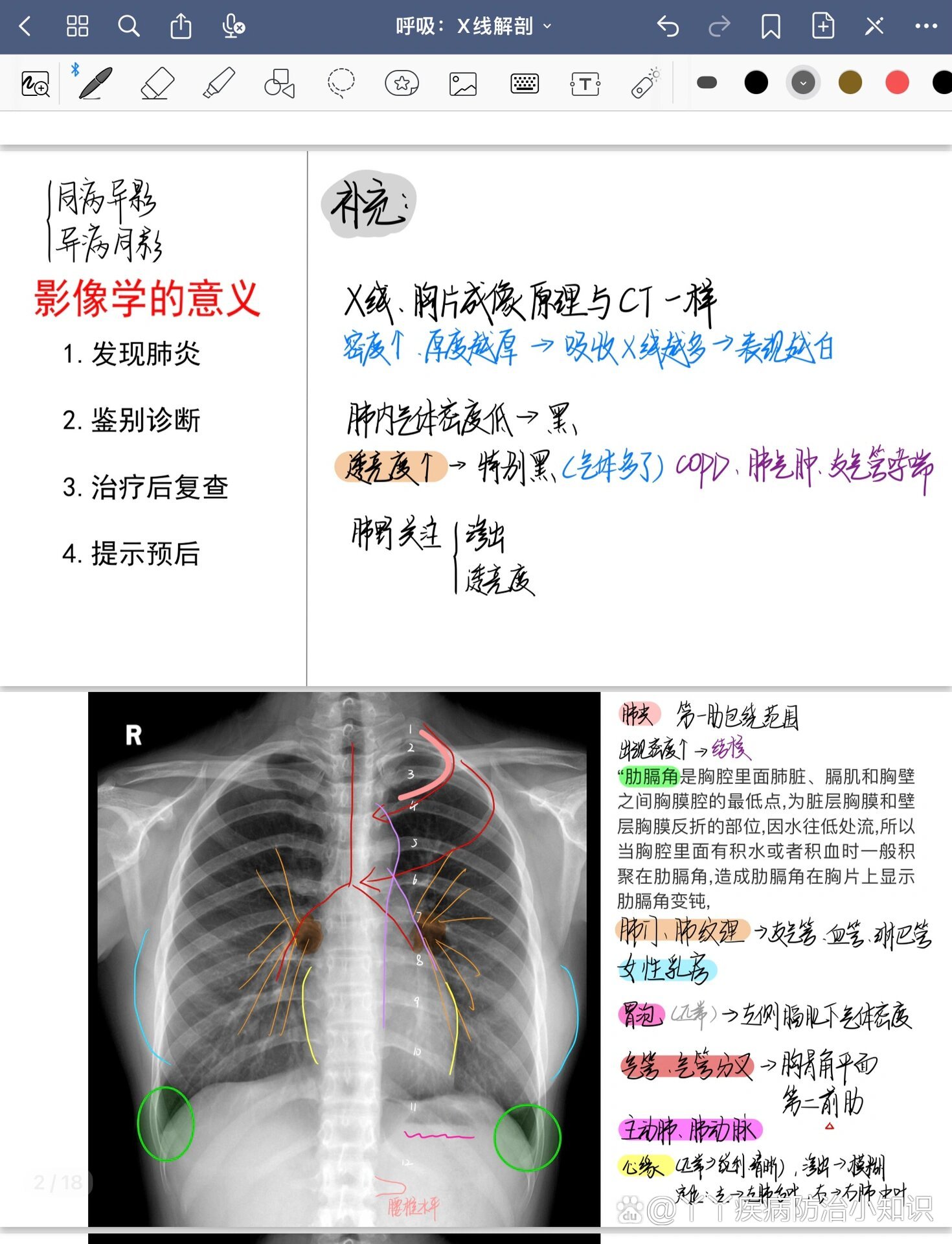 肺部x光片怎么看图片