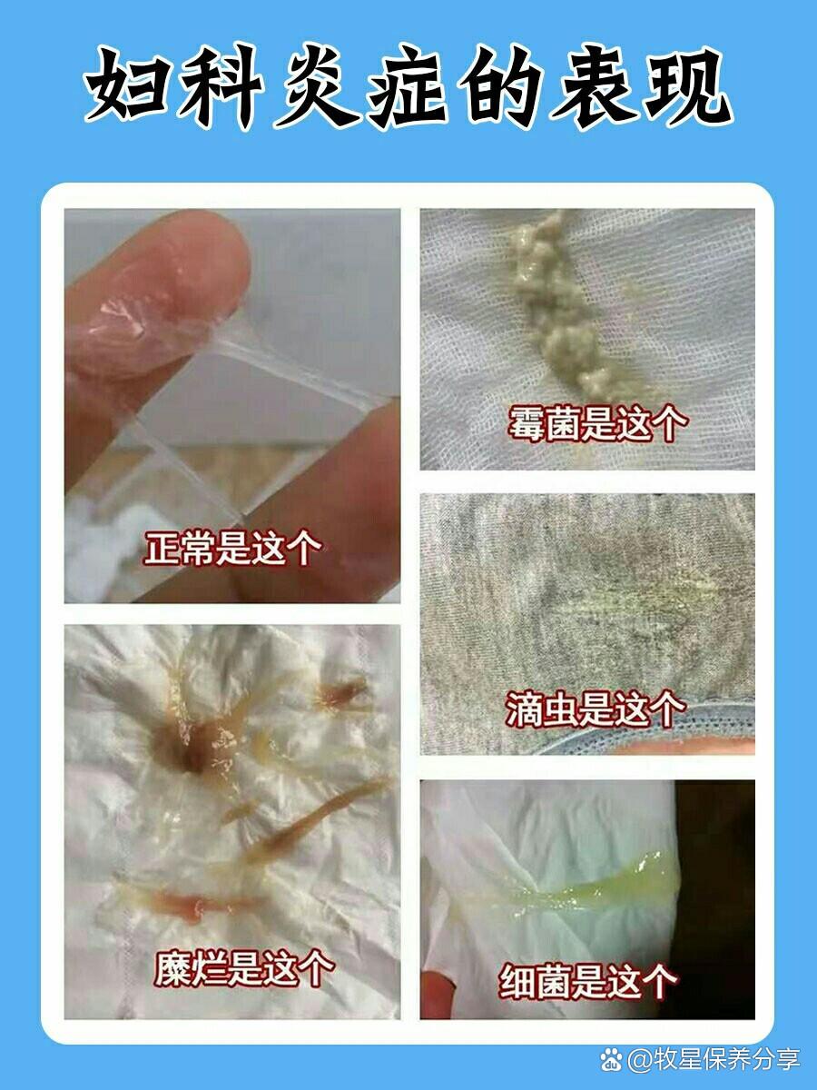 滴虫的症状图片