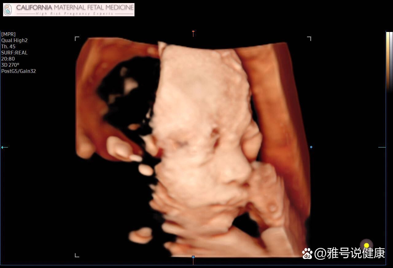 医生说你的宝宝是单脐动脉(sua)