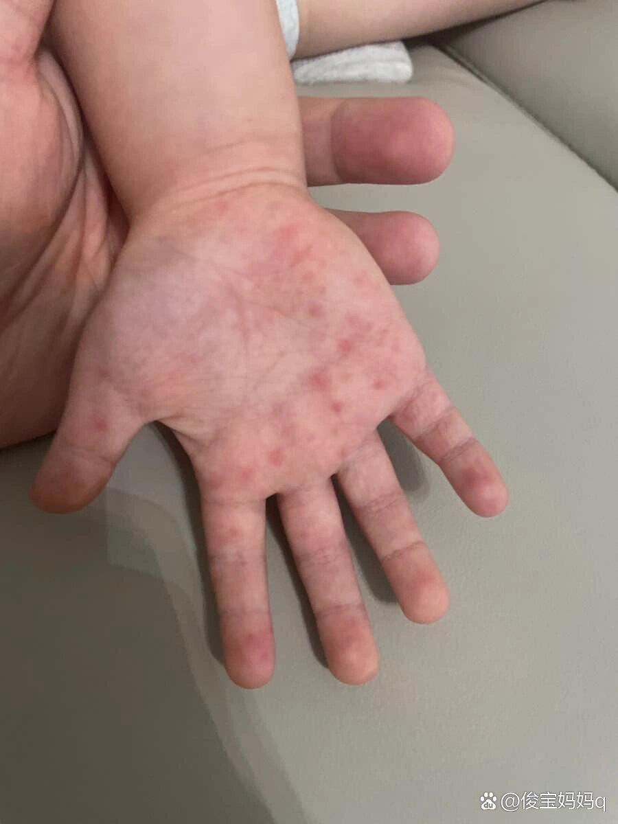 今天突然发现孩子手心有红点,什么原因啊?