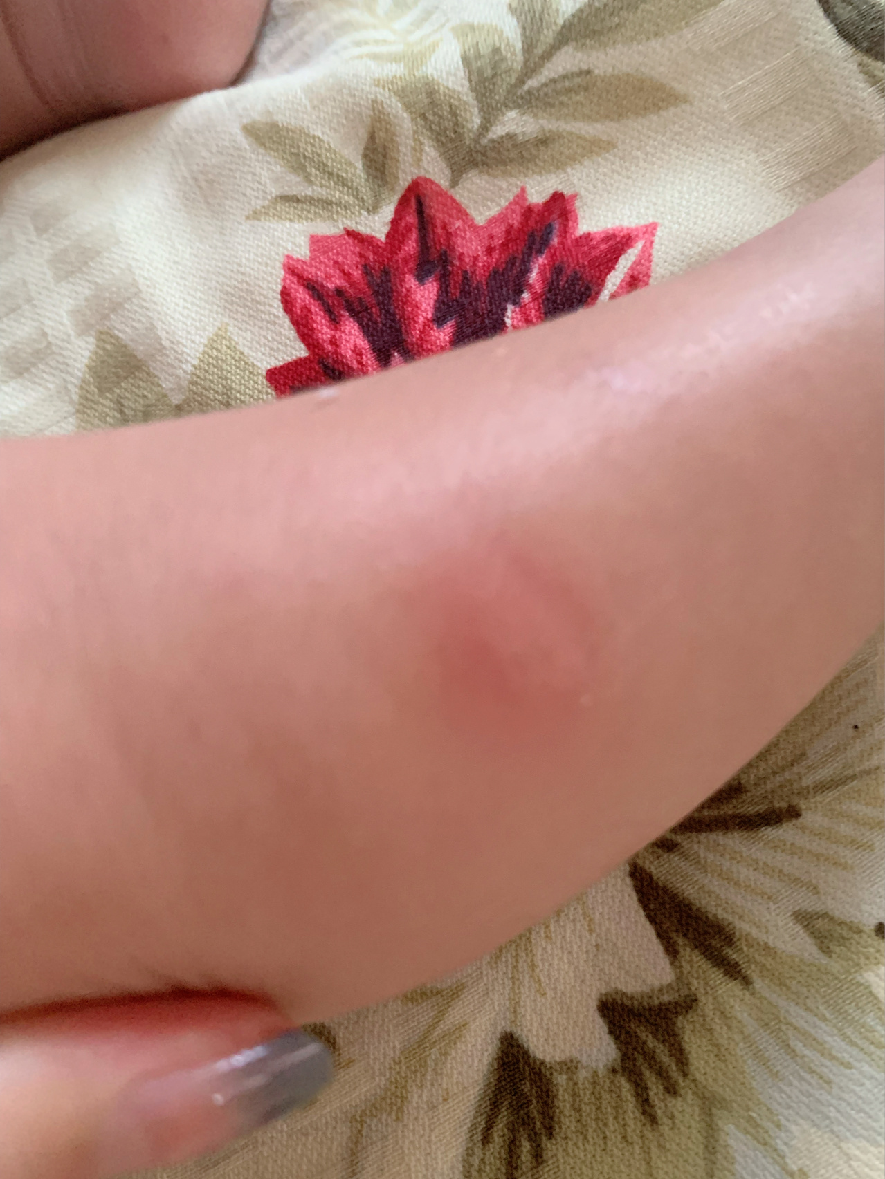 宝宝早上起来脚上就起了一个大包