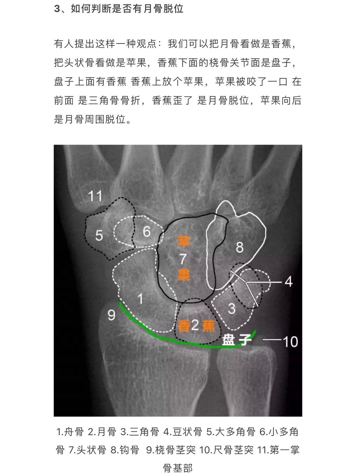 腕关节脱位x线报告图片