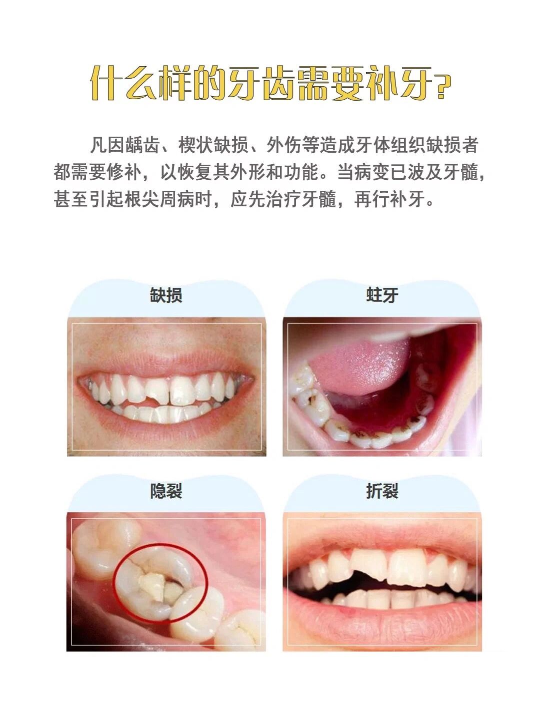 牙齿没有自我修复功能,牙齿缺损时,就需要进行补牙