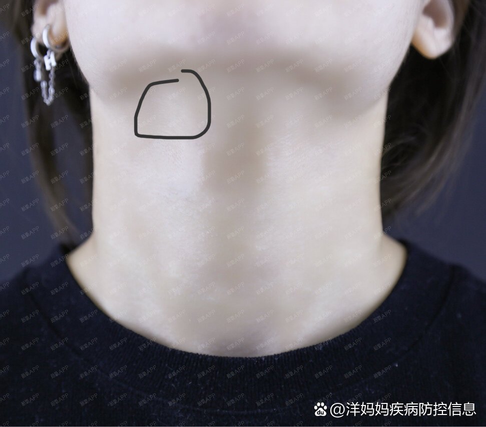 左边脖子这个地方摸起来有硬硬的一个小鼓包,按压会痛,有时会感觉扯到