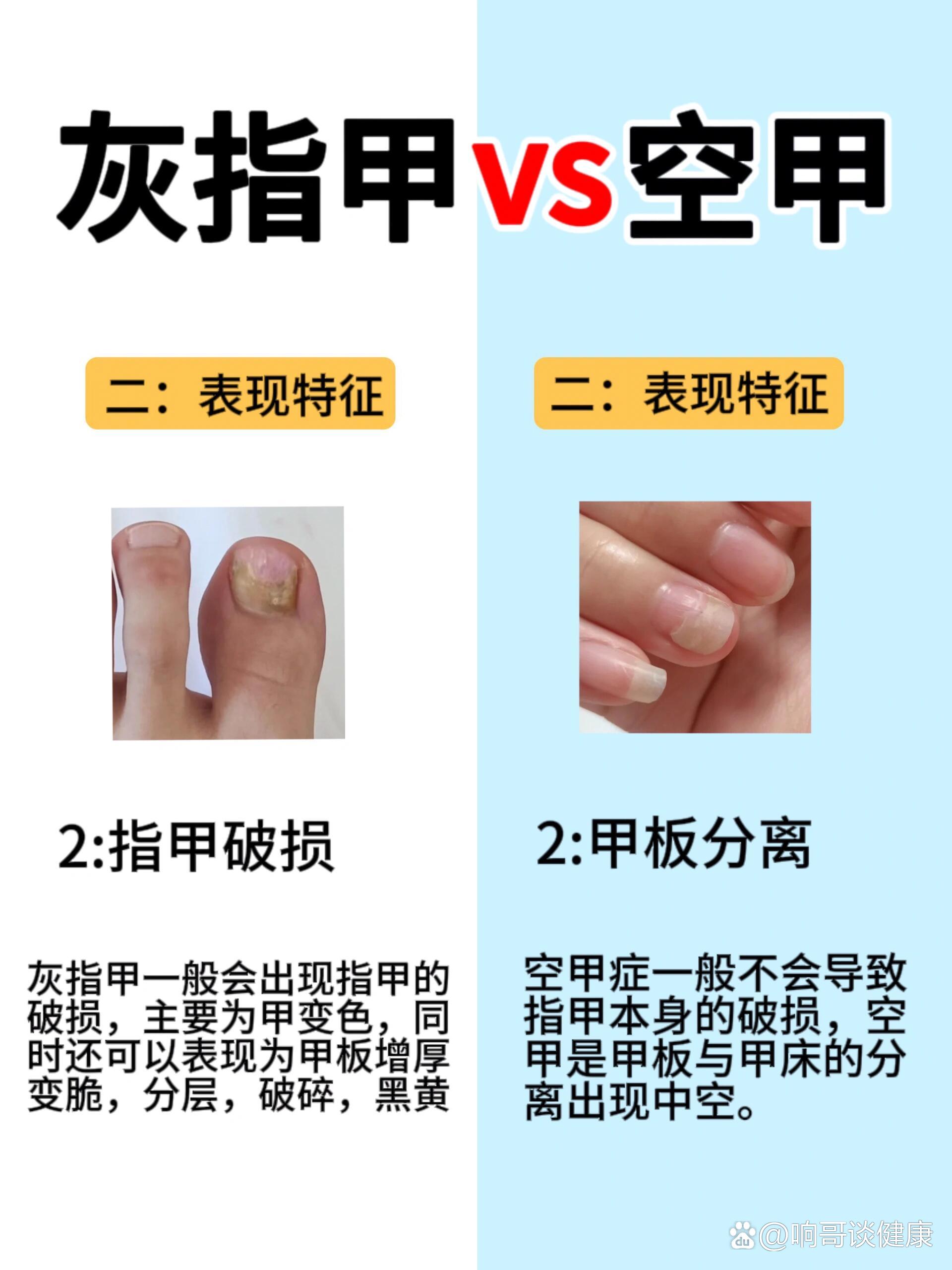 来自查:灰指甲和空甲别傻傻分不清!