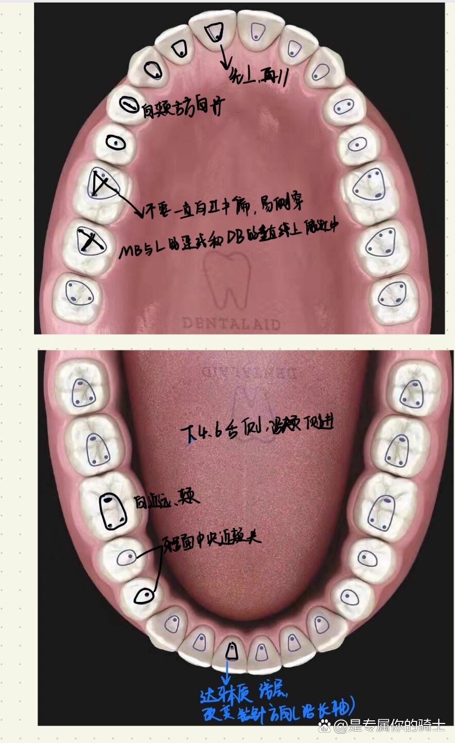 下颌六的开髓形态图片图片