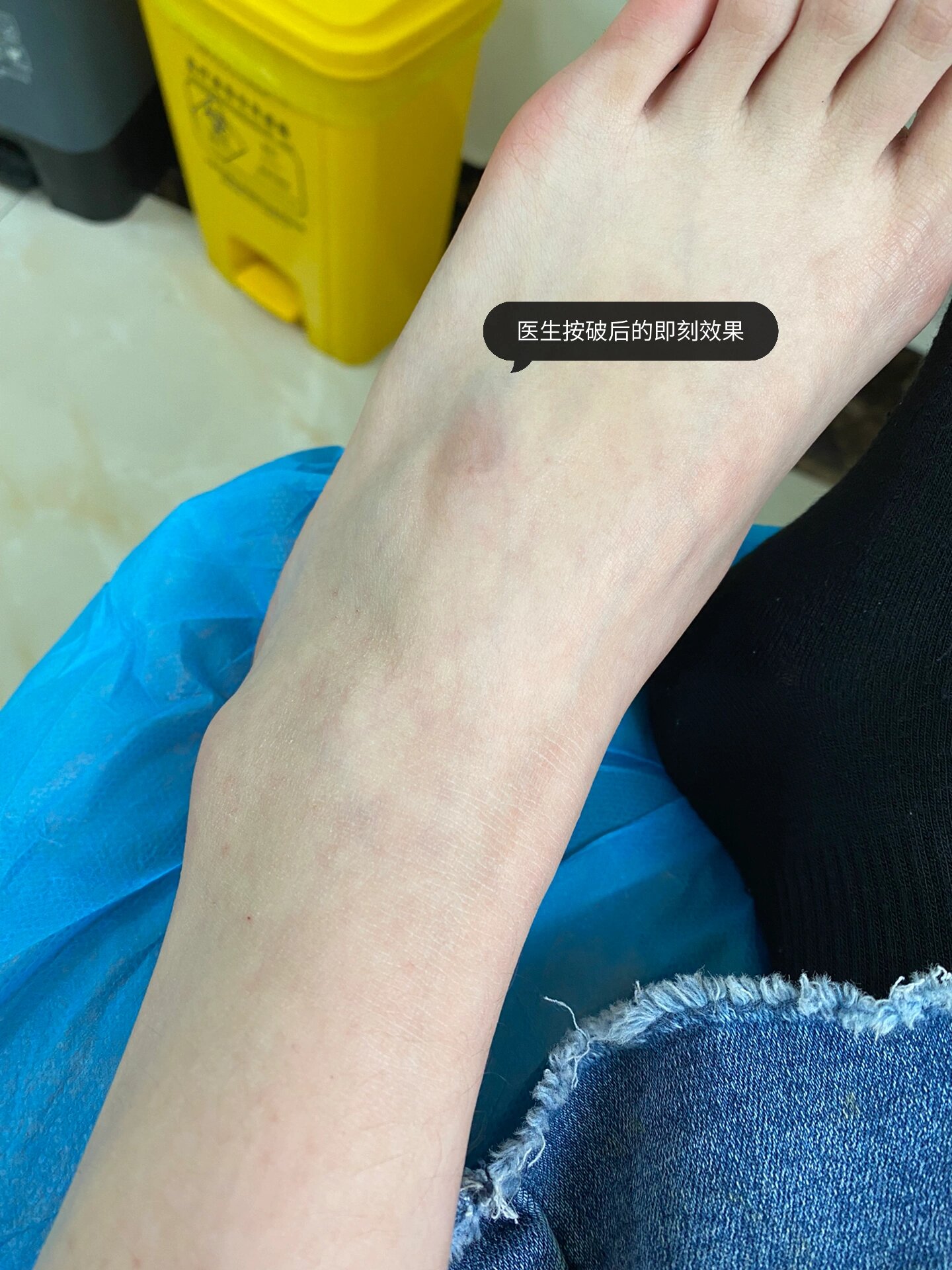 腱鞘囊肿终于被治疗了