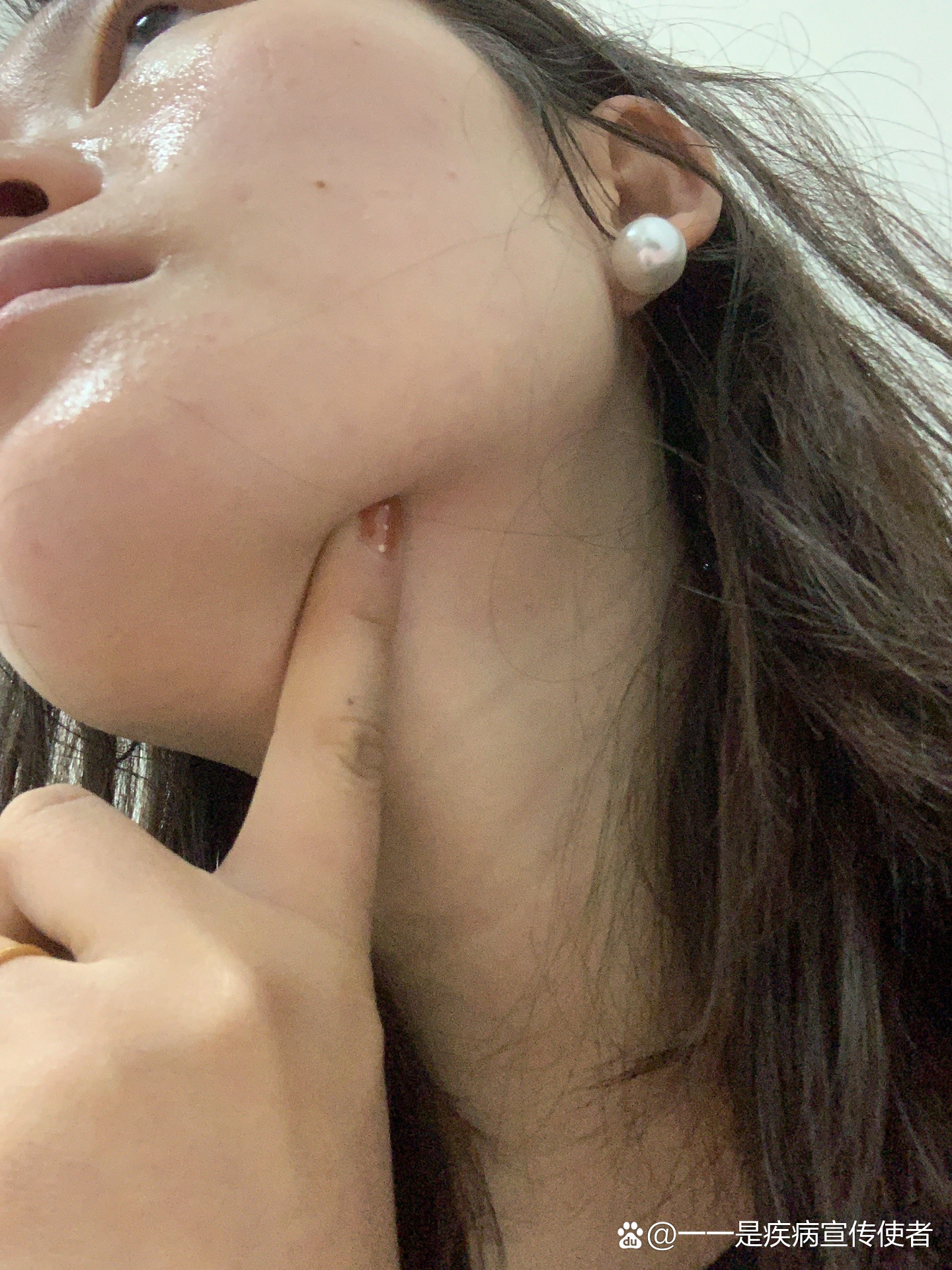 颌下腺炎症还是淋巴结发炎?