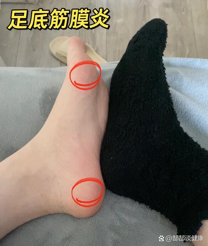 足底筋膜炎